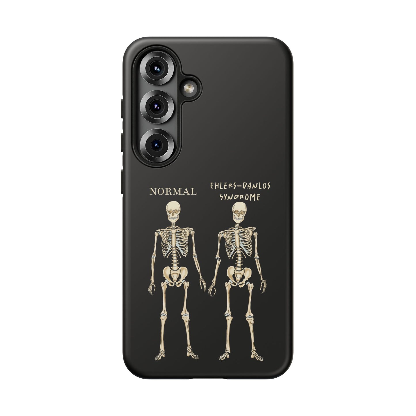 Black phone case with side-by-side skeletons—one labeled “normal,” the other “Ehlers-Danlos Syndrome”—to spread awareness about EDS and its effects.